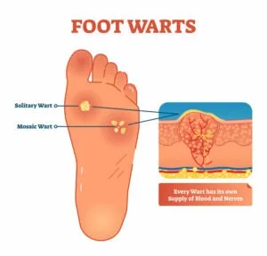 Foot warts vector illustration. Medical scheme with solitary and mosaic warts. Close-up cross section with wart and its own supply of blood and nerves.